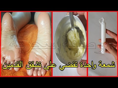 علاج تشققات الأقدام لتوضع في الليل وفي الصباح