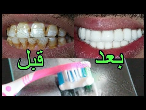 شاهد خلطة سهلة للحصول على أسنان بيضاء