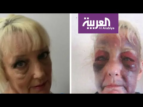 شاهد صور صادمة لعجوز بريطانية تتعرض للضرب من صديقها