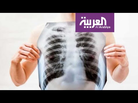 شاهد الفرق بين الالتهاب الرئوي بسبب كورونا والتقليدي